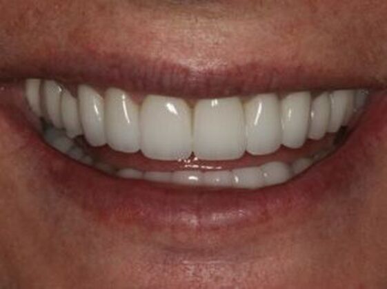 Smile Makeover Case 3 - After