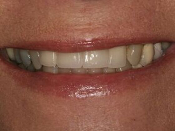 Smile Makeover: Case 4 - Before