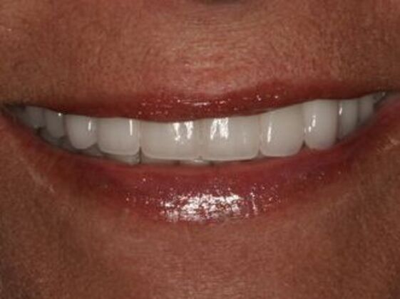 Smile Makeover: Case 4 - After