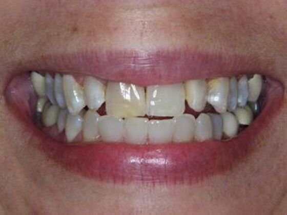 Smile Makeover Case 6 - Before