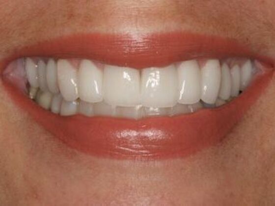 Smile Makeover Case 6 - After
