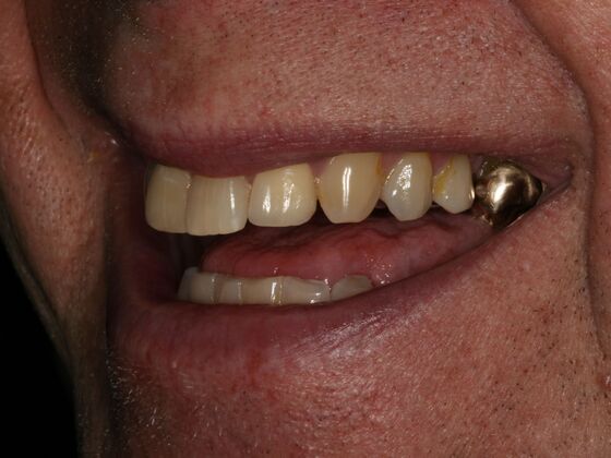 Dental Implants Case 2 - Before