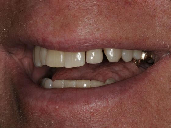 Dental Implants Case 2 - After