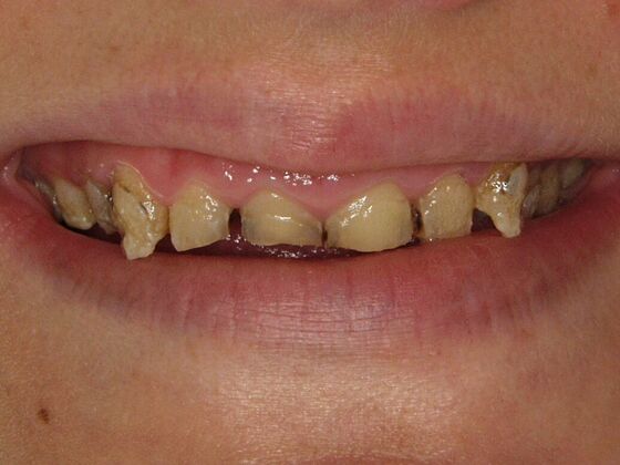 Smile Makeover Case 7 - Before