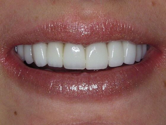 Smile Makeover Case 7 - After