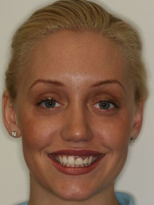Cosmetic Dentistry Veneers and Crowns - Before