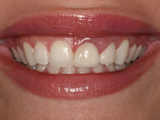Smile Makeover Case 2: Kristi - Before