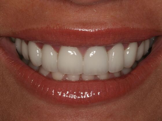 Smile Makeover Case 2: Kristi - After