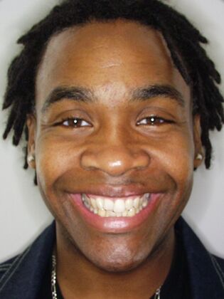 Cosmetic Dentistry Instant Orthodontics - Before