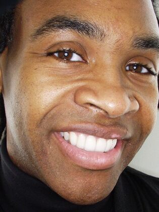 Cosmetic Dentistry Instant Orthodontics - After