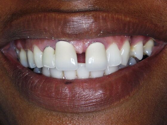 Smile Makeover Case 9 - Before