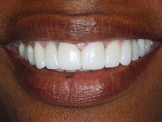 Smile Makeover Case 9 - After