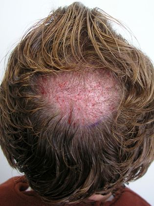 Crown Hair Restoration - Male: Crown (12) - Before