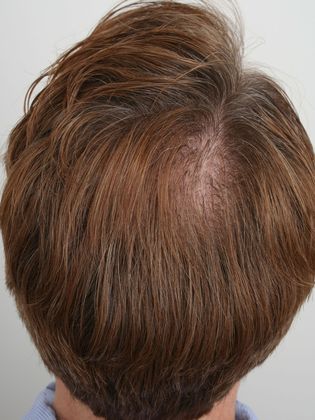 Crown Hair Restoration - Male: Crown (12) - After