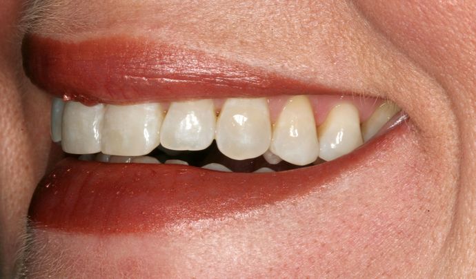 Teeth Whitening: Case 3 - After