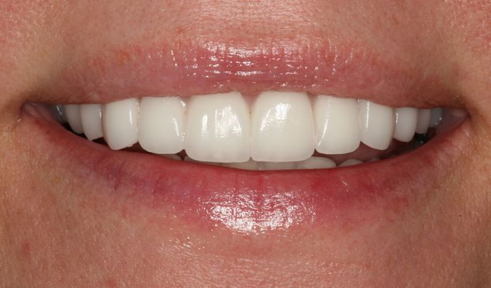Restorative Dentistry: Case 1 - After