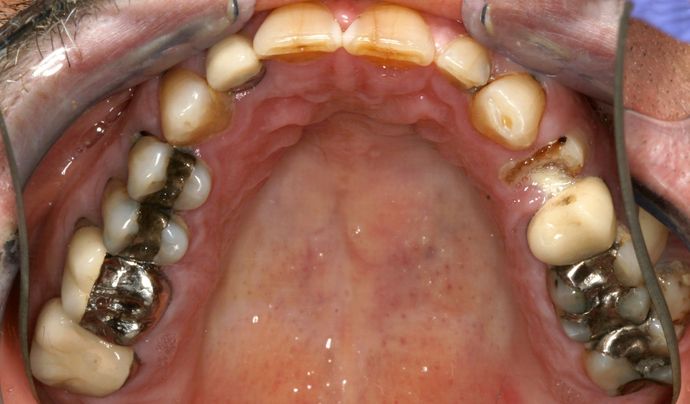 Full Mouth Reconstruction: Case 1 - Before