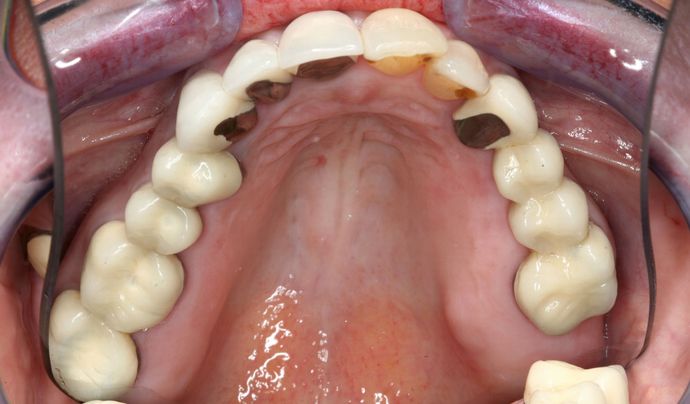Dental Bridges: Case 1 - Before
