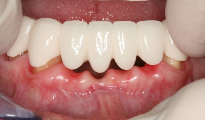 Dental Bridges: Case 1 - Bridge 2 P3