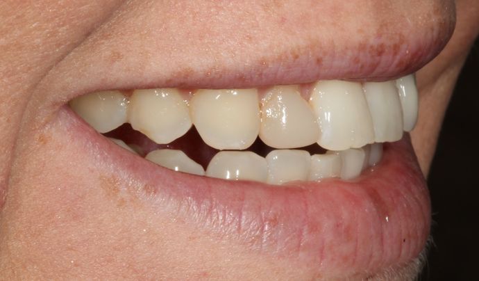 Dental Bridges: Case 2 - Before