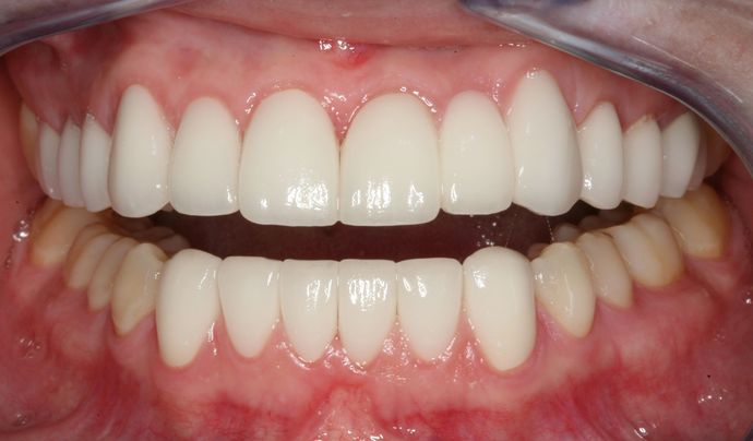 Dental Bridges: Case 2 - After