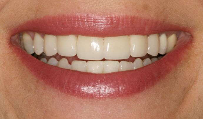 Laser Dentistry: Case 1 - After