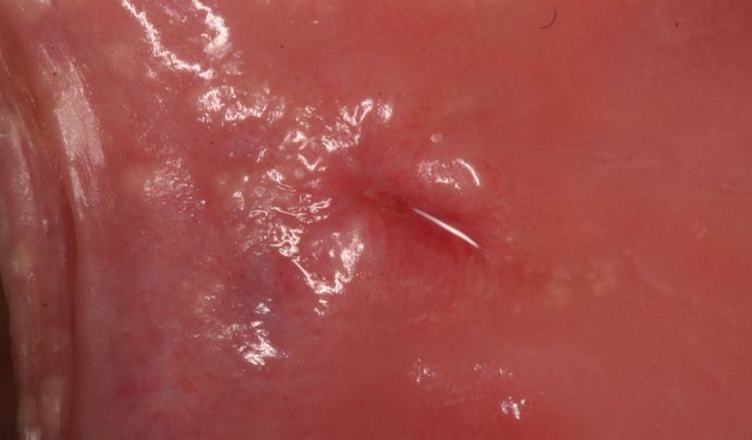 Laser Dentistry: Case 4