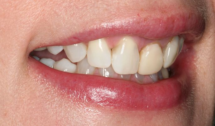 Laser Dentistry: Case 5 - Before