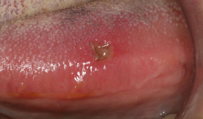 Laser Dentistry: Case 6