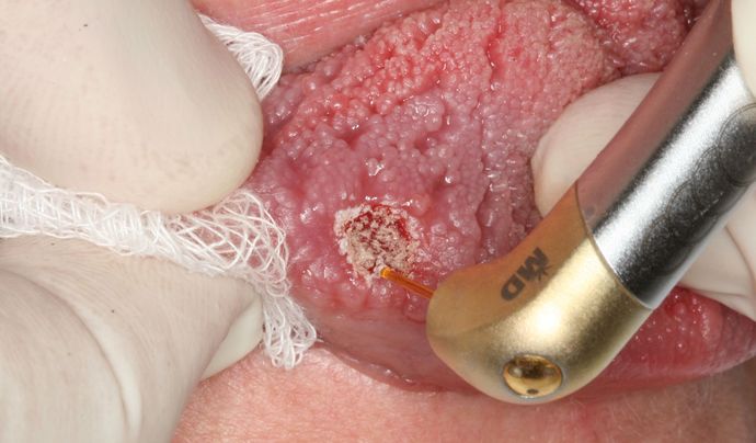 Laser Dentistry: Case 8