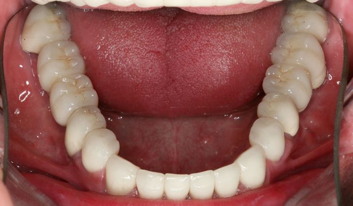 Full Mouth Reconstruction: Case 2 - After