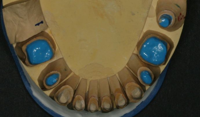 Full Mouth Reconstruction: Case 3 - Models