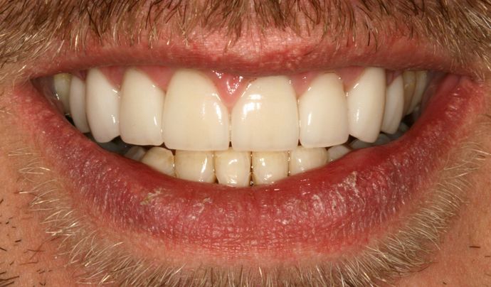 Gum Recontouring: Case 4 - After