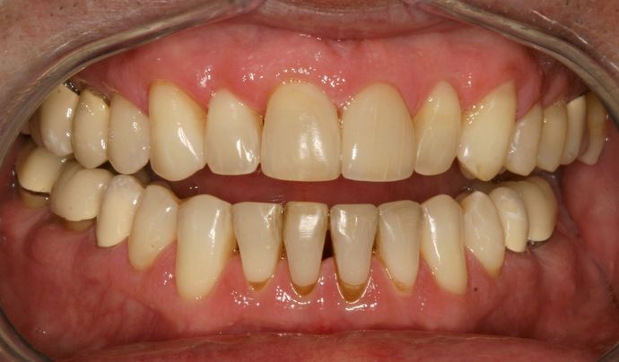 Bonding: Case 2 - After