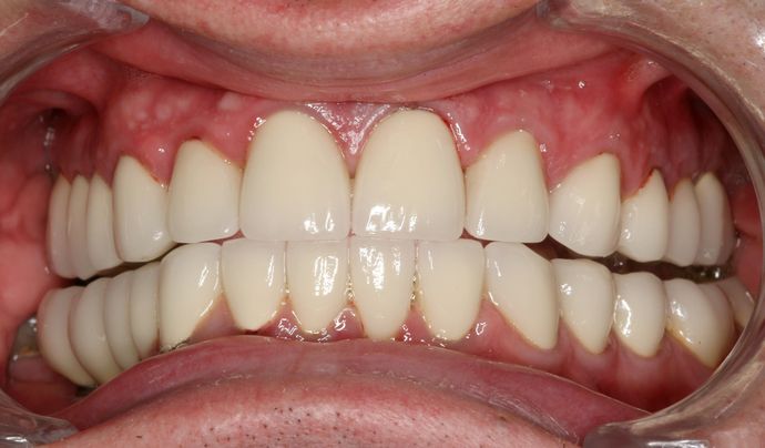 Full Mouth Reconstruction: Case 5 - After