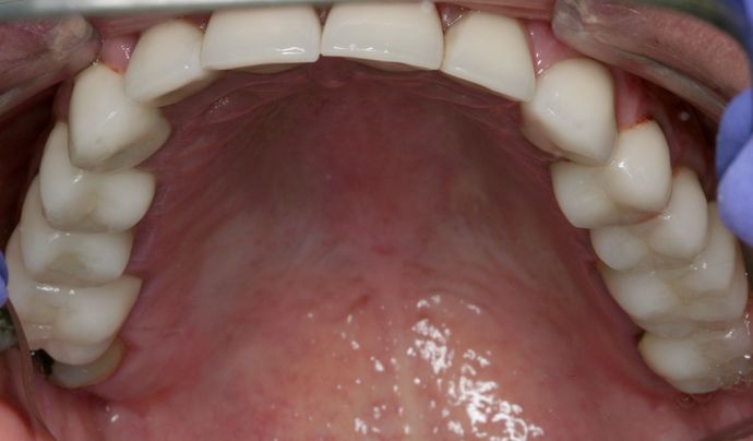 Full Mouth Reconstruction: Case 5 - After