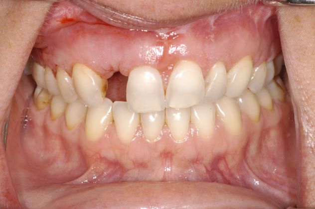 Porcelain Veneers: Case 1 - Before missing tooth