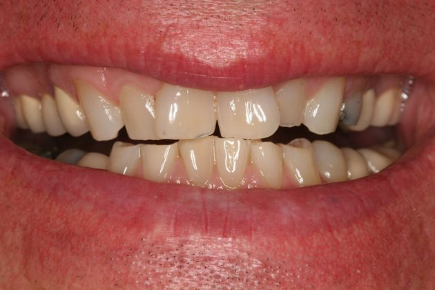 Porcelain Veneers: Case 27: Willow Grove - Before