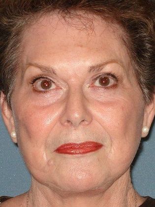 Face & Neck Lifts Case 2 - After