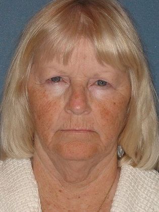 Face & Neck Lifts Case 3 - Before