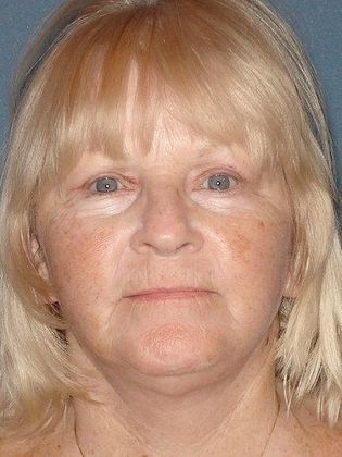 Face & Neck Lifts Case 3 - After