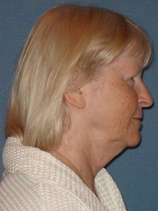 Face & Neck Lifts: Case 3 - Before - Full Facelift and Neck Liposuction 