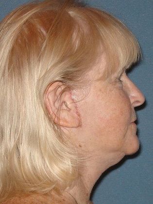 Face & Neck Lifts: Case 3 - 4-Weeks After