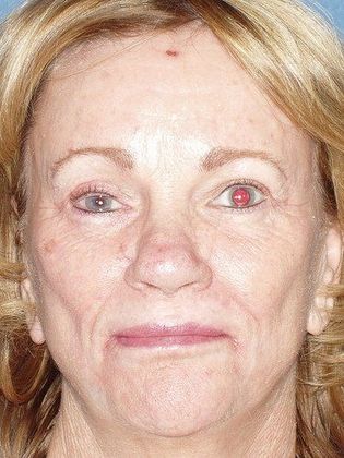 Lip Augmentation Case 1 - Before