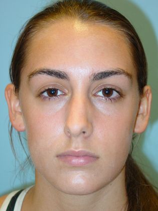 Rhinoplasty: Case 1 - Before