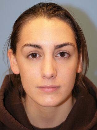 Rhinoplasty: Case 1 - After