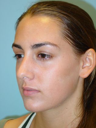 Rhinoplasty: Case 1 - Before