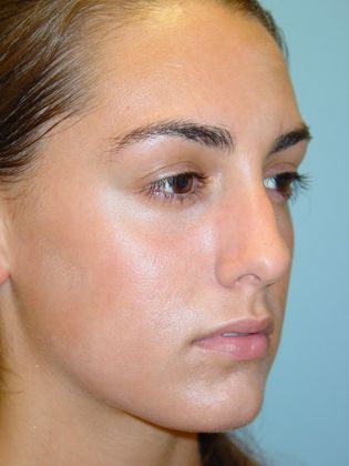 Rhinoplasty: Case 1 - Before