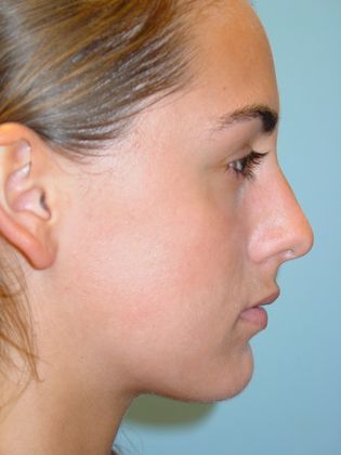 Rhinoplasty: Case 1 - Before