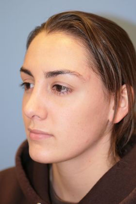 Rhinoplasty: Case 1 - After
